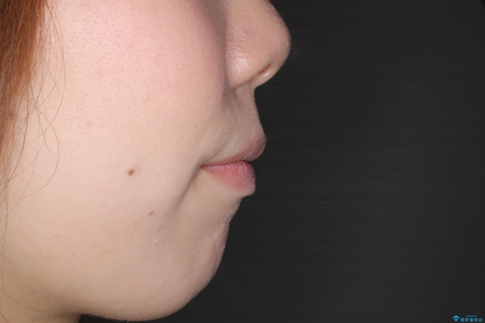 がたがたと出っ歯を直したい ワイヤーによる抜歯矯正の治療後(顔貌)