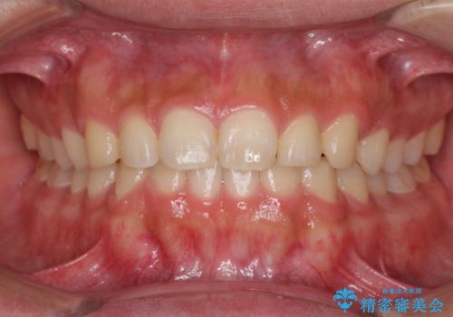 インビザラインによる、すきっ歯の改善の治療中