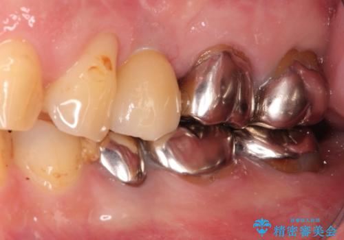小臼歯部のインプラントの治療後