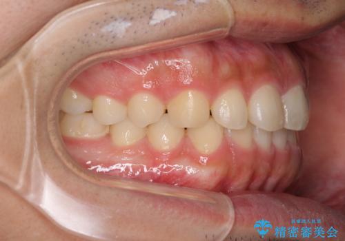 インビザラインによる、すきっ歯の改善の治療中