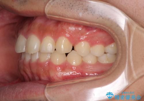 インビザラインによる、すきっ歯の改善の治療中