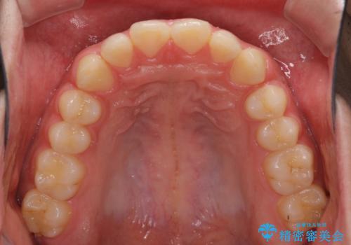 インビザラインによる、すきっ歯の改善の治療中