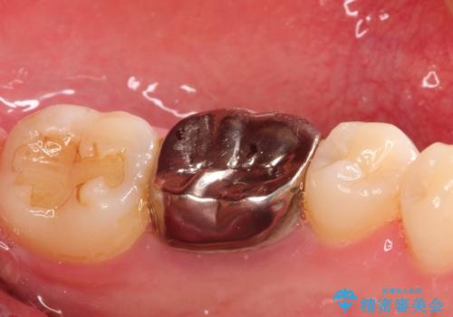 銀歯を白くしたい セラミッククラウンの治療前