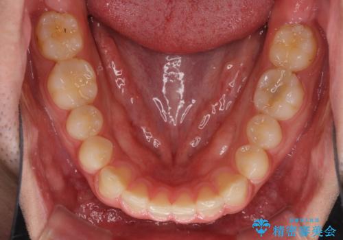 インビザラインによる、すきっ歯の改善の治療中
