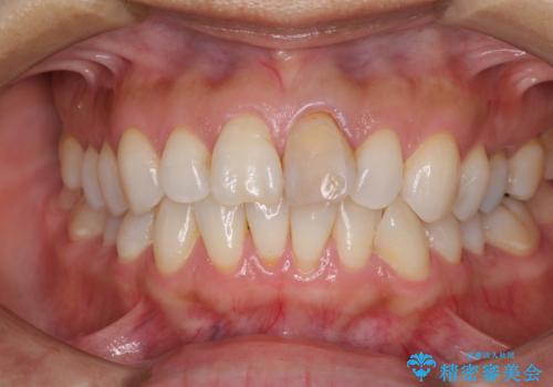 変色した前歯が気になる オールセラミッククラウンの治療前