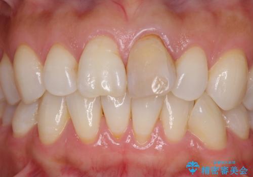 変色した前歯が気になる オールセラミッククラウンの治療前