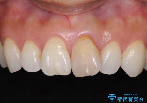 変色した前歯が気になる オールセラミッククラウンの治療前