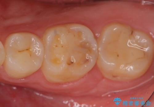 セラミックインレー 虫歯治療の症例 治療前