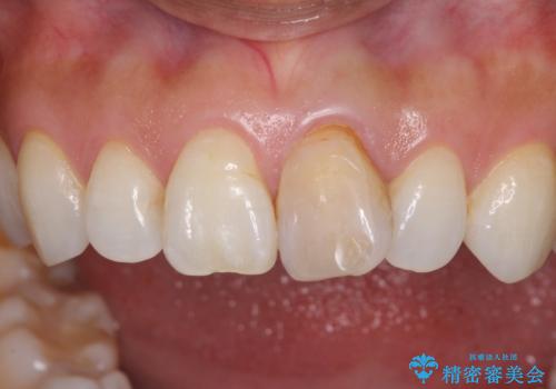 変色した前歯が気になる オールセラミッククラウンの治療前