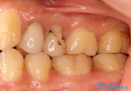 歯肉の中までの深い虫歯　部分矯正後のセラミック治療の治療前