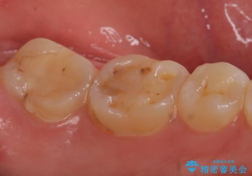 セラミックインレー 虫歯治療の治療前