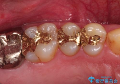精密なむし歯の治療　ゴールドインレーの治療後