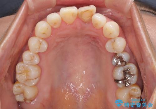 変色した前歯が気になる オールセラミッククラウンの治療前