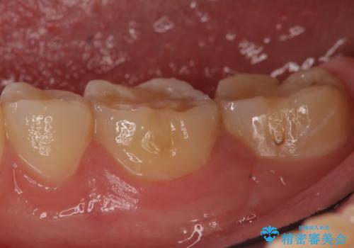 セラミックインレー 虫歯治療の治療前