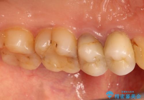 歯肉の中までの深い虫歯　部分矯正後のセラミック治療の治療前