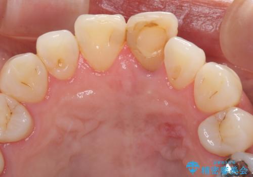 変色した前歯が気になる オールセラミッククラウンの治療前