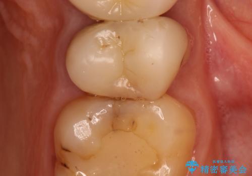 歯肉の中までの深い虫歯 部分矯正後のセラミック治療の治療前