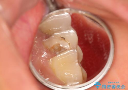 歯肉の中までの深い虫歯 部分矯正後のセラミック治療の治療前