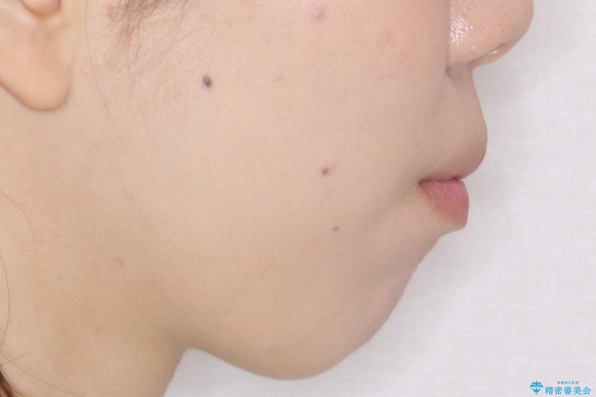 がたがたと出っ歯を直したい ワイヤーによる抜歯矯正の治療前(顔貌)