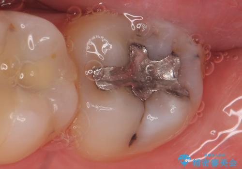 セラミックインレー 古い銀歯の治療の治療前