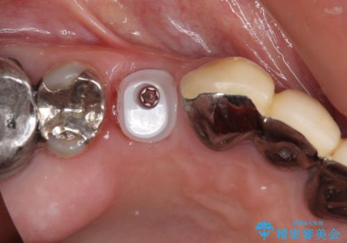 小臼歯の審美治療 ストローマンインプラントとカスタムアバットメントの治療中