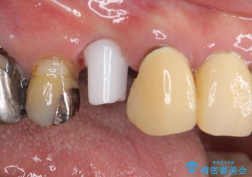 小臼歯の審美治療　ストローマンインプラントとカスタムアバットメントの治療中