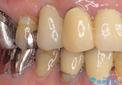 小臼歯の審美治療 ストローマンインプラントとカスタムアバットメントの治療後