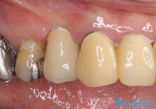 小臼歯の審美治療　ストローマンインプラントとカスタムアバットメントの治療後