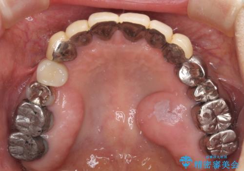 小臼歯の審美治療 ストローマンインプラントとカスタムアバットメントの治療後