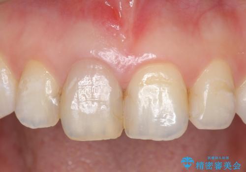 オールセラミッククラウン(スペシャル) 変色が気になる前歯部の補綴の治療前