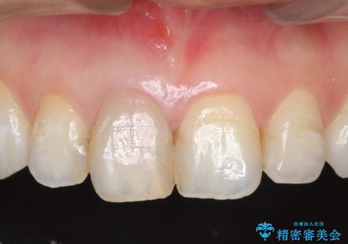 オールセラミッククラウン(スペシャル)　変色が気になる前歯部の補綴の治療前