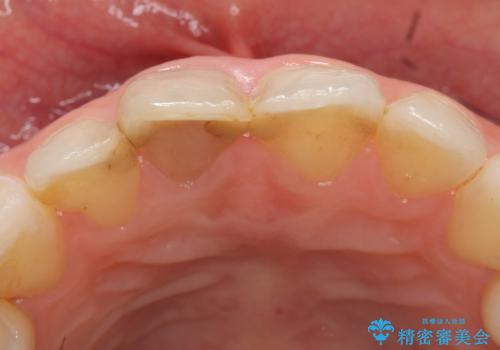 オールセラミッククラウン(スペシャル) 変色が気になる前歯部の補綴の治療前