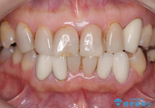 オールセラミッククラウン 前歯部の見た目の改善の治療前