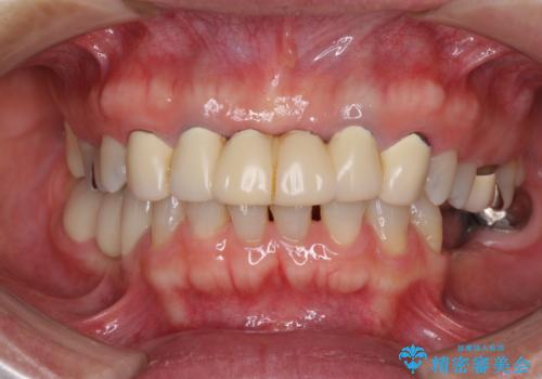 飛行機を利用しての通院 気になる所を全て治療する総合歯科治療の治療前