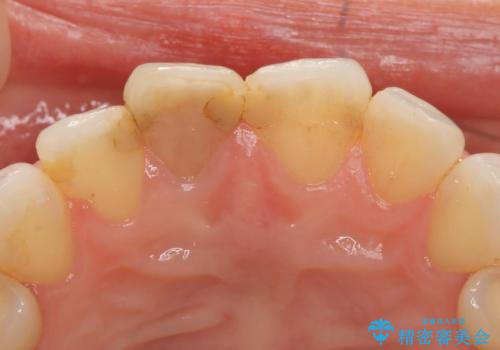 オールセラミッククラウン(スペシャル) 変色が気になる前歯部の補綴の治療前
