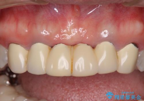 飛行機を利用しての通院 気になる所を全て治療する総合歯科治療の治療前