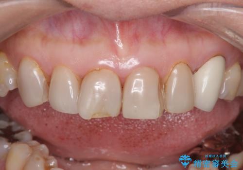 オールセラミッククラウン　前歯部の見た目の改善の治療前
