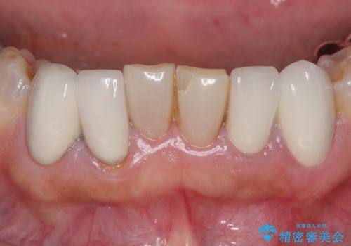 オールセラミッククラウン 前歯部の見た目の改善の治療前