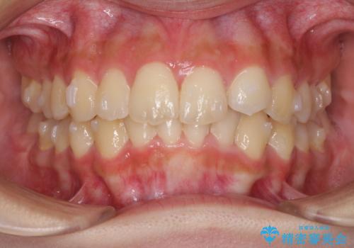 前歯のガタガタを目立たない装置でなおしたい　インビザラインによる目立たない矯正の治療中