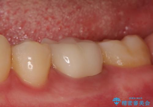 銀歯を白くしたい セラミッククラウンの治療後