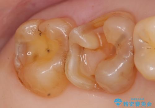 セラミックインレー 古い銀歯のやり替えの治療中
