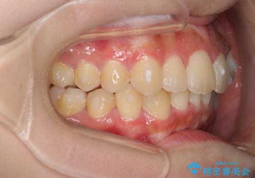 前歯のガタガタを目立たない装置でなおしたい インビザラインによる目立たない矯正の治療中