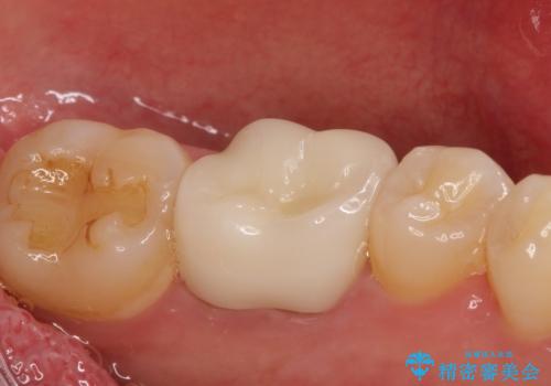 銀歯を白くしたい セラミッククラウンの治療後