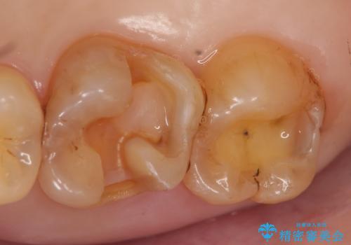 セラミックインレー 古い銀歯のやり替えの治療中