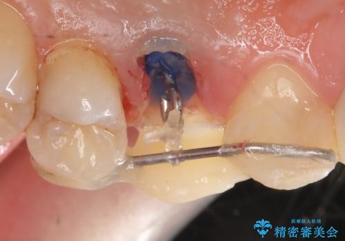 オールセラミッククラウン 歯牙の挺出後の補綴の治療前