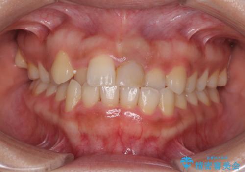 前歯の反対咬合　非抜歯のワイヤー矯正の症例 治療前