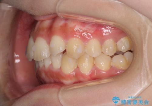 前歯のガタガタを目立たない装置でなおしたい インビザラインによる目立たない矯正の治療中