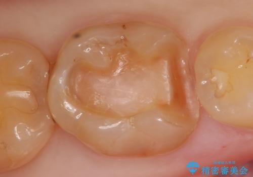 セラミックインレー 銀歯を白くの治療中