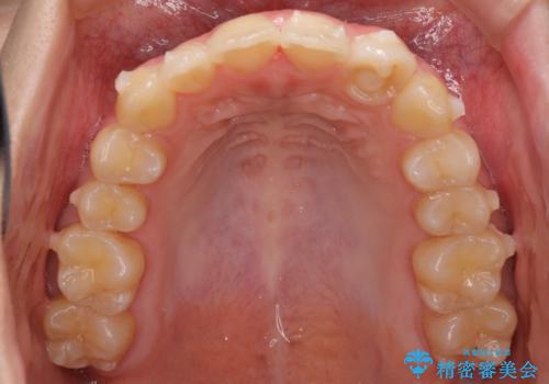 前歯のガタガタを目立たない装置でなおしたい インビザラインによる目立たない矯正の治療中