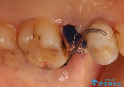 歯肉の中までの深い虫歯 部分矯正後のセラミック治療の治療前